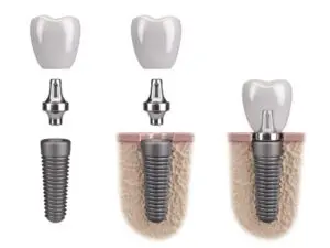Tooth human implant Titan Zahnimplantat