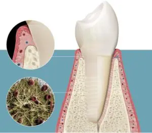 keramik-zahnimplantat keramik zahnimplantat